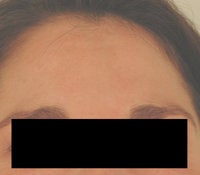 Melasma Treatment after 120086