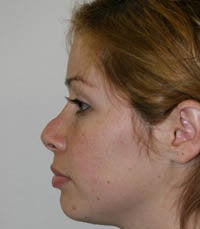 Revision Rhinoplasty before 222492