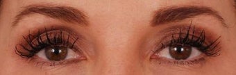 Eyelash Growth from Latisse after 271675