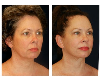Facial Rejuvenation after 374118