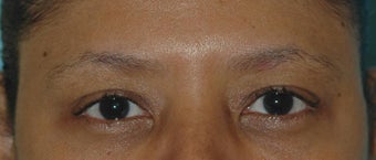 Botox Treatment before 93600