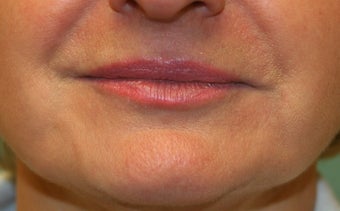 Restylane around the mouth after 240869