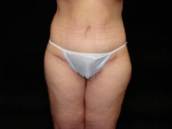 Body Lift, Outer Thigh Lift, Buttocks Lift after 203464
