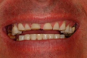 Smile Makeover With Empress All Ceramic Crowns before 96899
