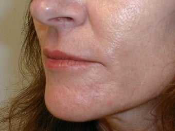 Dermabrasion after 593769