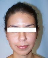 Ear Surgery (otoplasty) after 124881