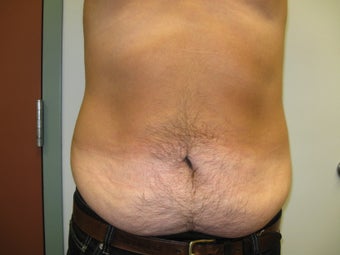 Abdominoplasty on 42 Year Old Male before 340025