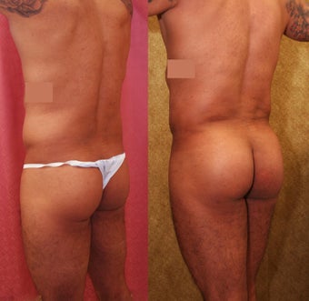 Brazilian buttock augmentation with fat grafting to the buttocks with liposuction in Los Angeles before 583433