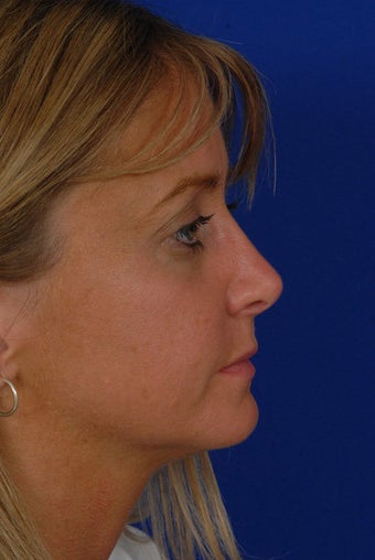 Revision Rhinoplasty after 274191