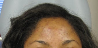 Vi Peel for acne and hyperpigmentation after 298237
