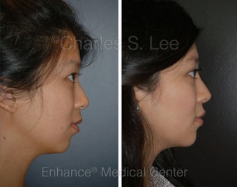 Blepharoplasty, Rhinoplasty, Chin Augmentation before 426962