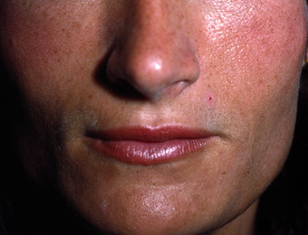 Facial Volumizing with Fillers after 149191
