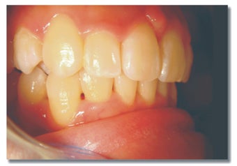 Invisalign for severe crowding/ non extraction 310074