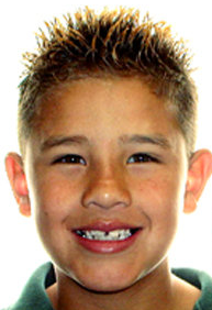 Two-Phase Orthodontic Treatment before 344259