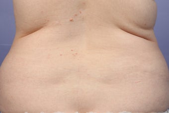CoolSculpting to Bra Rolls/Back Fat before 414959