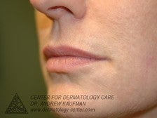 Juvederm Injection to Augment Lip Line before 315096