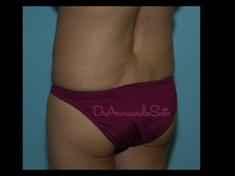 Brazilian Butt Lift before 157533