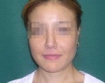 Nose Surgery -Rhinoplasty after 519261