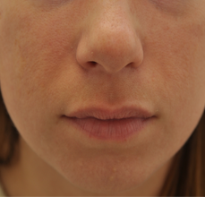Acne Scarring after 426033