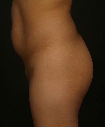 Brazilian Butt Lift before 271526