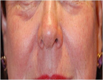 CO2 Laser Resurfacing ~ Active & Deep FX after 130743