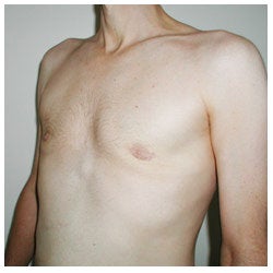 Periareolar Excision Gynecomastia / Liposuction after 334404