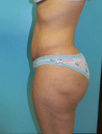 Brazilian Butt Lift- Fat transfer 372611