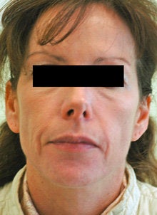 Laser Resurfacing before 89118