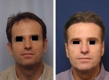 Hair replacement with Fleming/Mayer flap before 143618