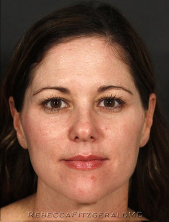 Restylane, Botox, Obagi Skin Care after 319351