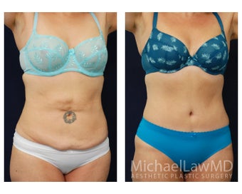 Abdominoplasty - Tummy Tuck after 629026