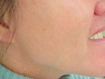 Photofacial Laser Treatment after 374393