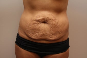 Tummy Tuck before 459609