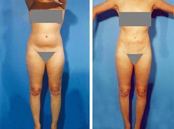 Liposuction before 636226