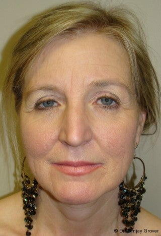 Facelift with browlift and lower blephorplasty before 617176