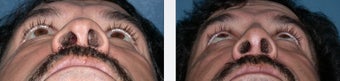 Hispanic Rhinoplasty before 346244