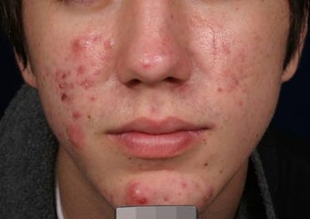 Acne laser treatment with PDT before 136715