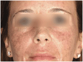 active fx fractional resurfacing before 267554