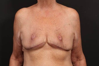 Breast reconstruction after 614909