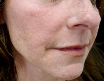 Mid Face and Lip Correction after 271681