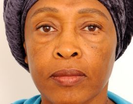 Lower Blepharoplasty (Lower Eyelids) before 376873