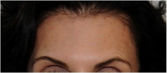 Botox after 66933