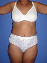 Body Contouring with Tummy Tuck after 133803