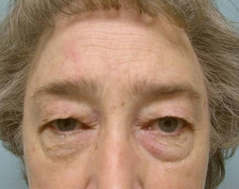 Upper and Lower Lid Blepharoplasty and Cheeklift before 148579