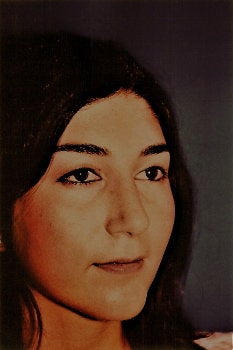 Rhinoplasty after 278369