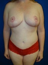 Breast Reduction, Mommy Makeover, Tummy Tuck (Abdominoplasty) after 412073