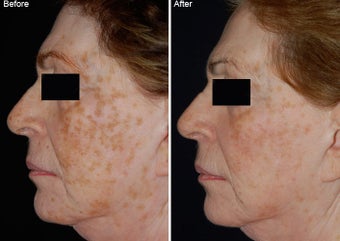 Fraxel Laser Resurfacing before 97775