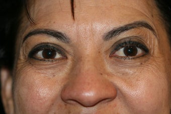 Botox before 584362