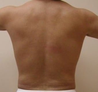 Liposuction love handles after 203477