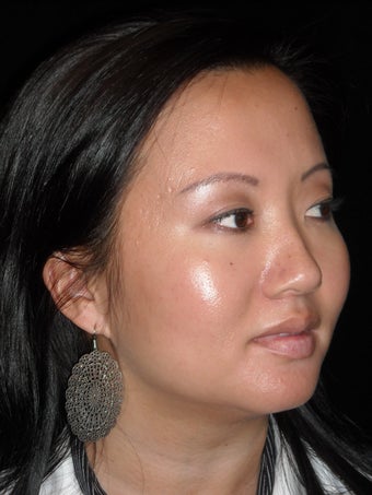 Lip augmentation with Juvederm before 234097